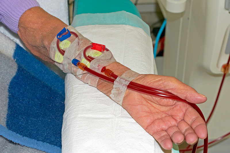 Dialysis Shunt Fistula