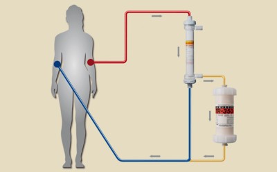 Schematische Darstellung der Apherese mit Adsorbermembran