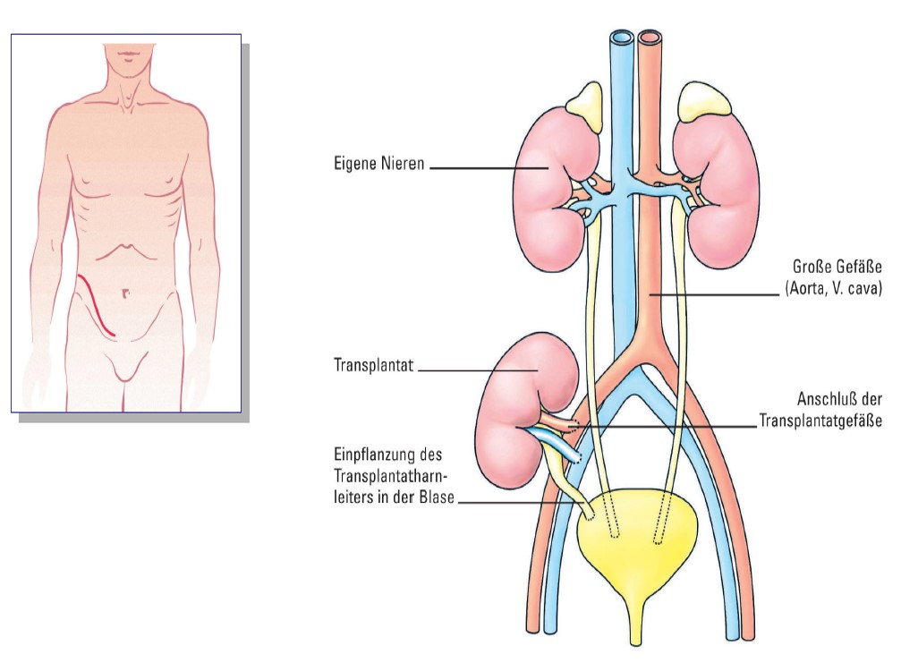 Nierentransplantation – Betreuung in Schwandorf